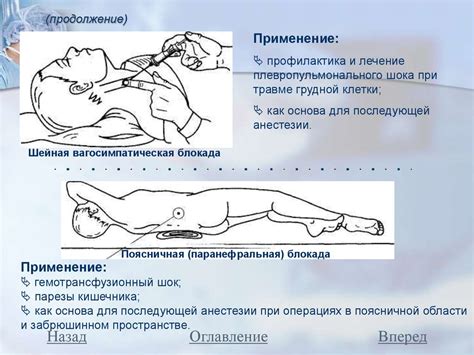 Преимущества ускорения прохождения анестезии