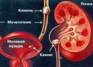 Признаки и причины появления камней в мочевом пузыре