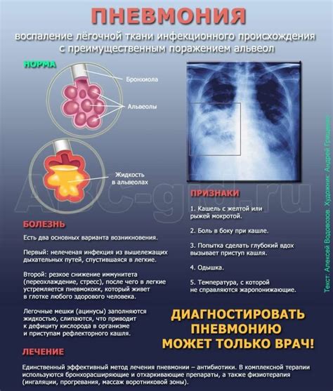 Признаки повторных случаев пневмонии