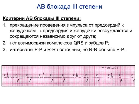 Признаки Av блокады i iii степени