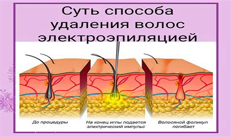 Принцип действия электроэпиляции и ее преимущества