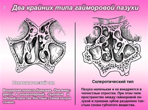 Пристеночное затемнение верхнечелюстных пазух носа