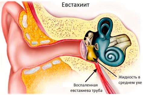 Причины возникновения воздуха в ухе