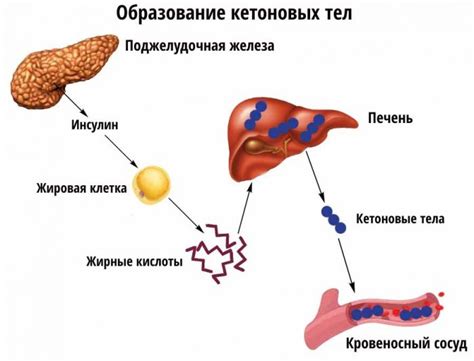 Причины возникновения кетоновых тел в моче