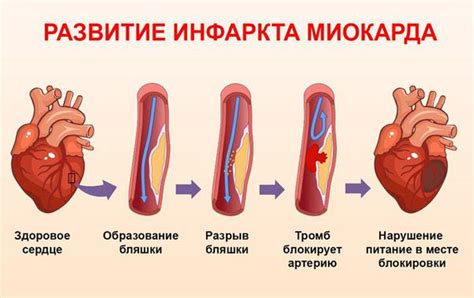 Причины возникновения нестабильности миокарда