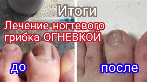 Причины возникновения ногтевого грибка