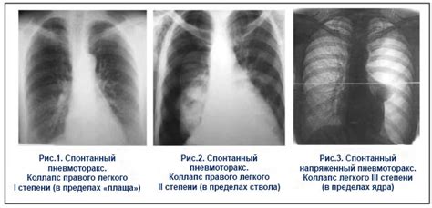 Причины возникновения пневмоторакса