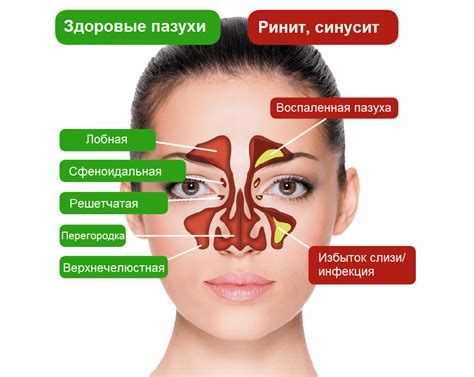 Причины возникновения пристеночного затемнения верхнечелюстных пазух носа