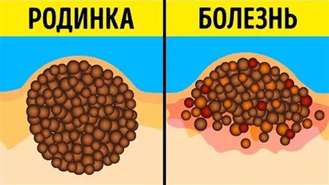 Причины возникновения родинок и возможные проблемы