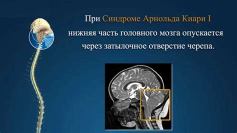 Причины возникновения синдрома Арнольда-Киари 1 степени