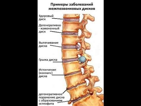 Причины возникновения спинальной грыжи S1-S2