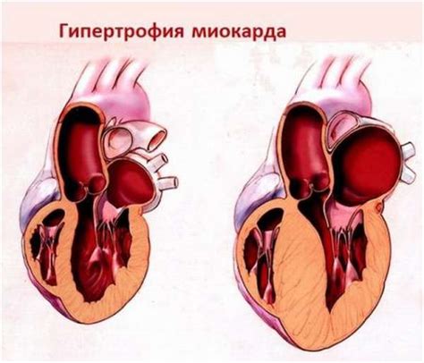 Причины гипертрофии миокарда