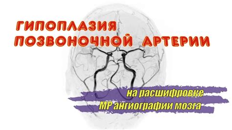 Причины гипоплазии поперечного синуса справа