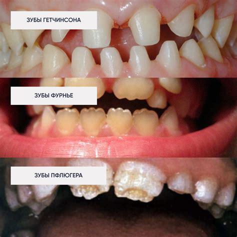 Причины гипоплазии эмали зубов и ее лечение
