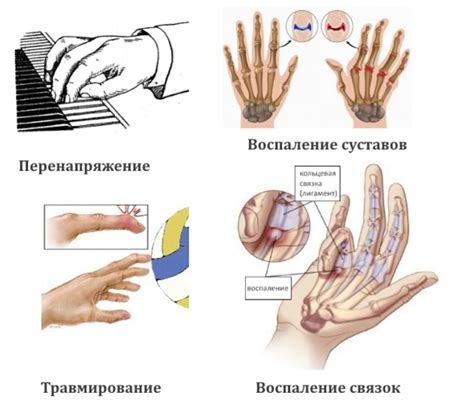 Причины заклинивания сустава на пальце руки