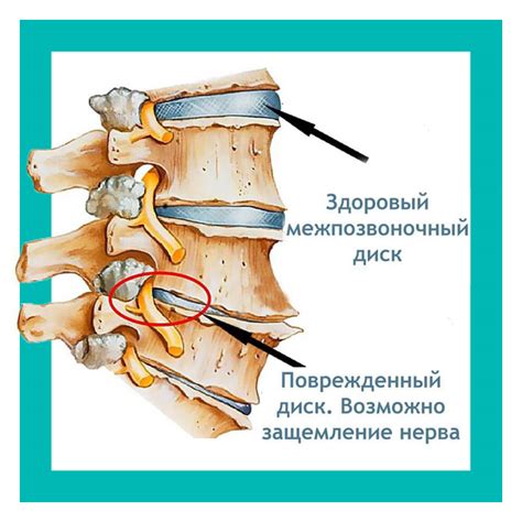 Причины защемления нерва в ноге