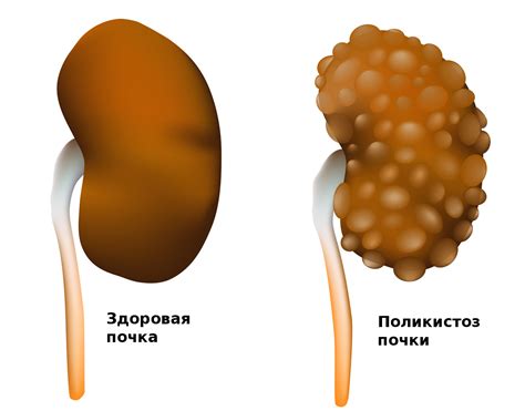 Причины и заболевания, связанные с мочой с хлопьями