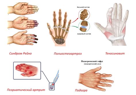 Причины и симптомы кручения суставов на руках