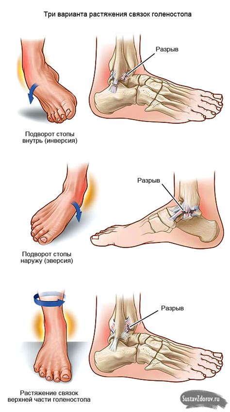 Причины и симптомы растяжения связок на голеностопе