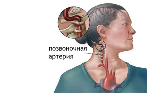 Причины и факторы риска развития спазма шейного отдела позвоночника