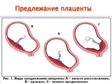 Причины плацентации по передней стенке