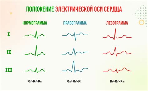 Причины полугоризонтального положения ЭОС на ЭКГ