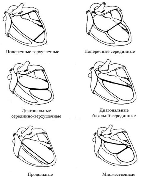 Причины появления дополнительных хорд