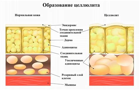 Причины появления целлюлита на ногах и ягодицах