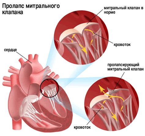 Причины пролапса митрального клапана