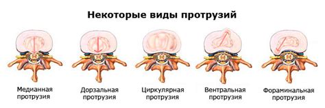 Причины протрузий дисков L4-S1