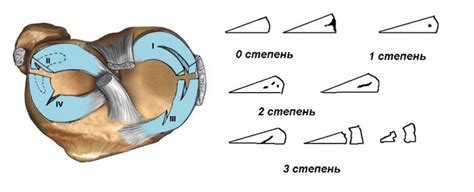 Причины развития мениска 2 степени