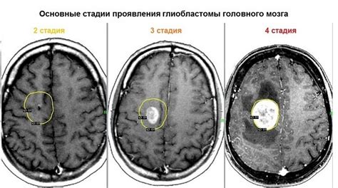 Причины развития опухоли головного мозга