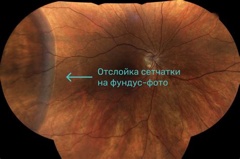 Причины развития отслойки сетчатки