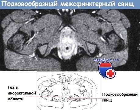 Причины свища