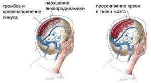 Причины слияния синусов головного мозга