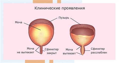 Причины снижения гипоксии детрузора мочевого пузыря