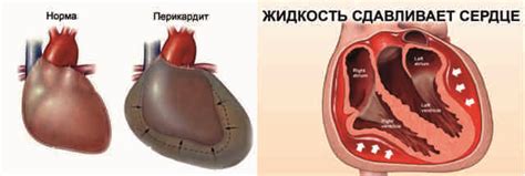 Причины увеличения количества жидкости в перикарде