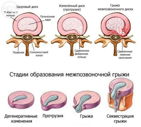 Причины экструзии межпозвоночного диска поясничного отдела