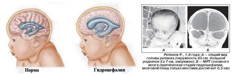 Прогноз развития плода при вентрикуломегалии