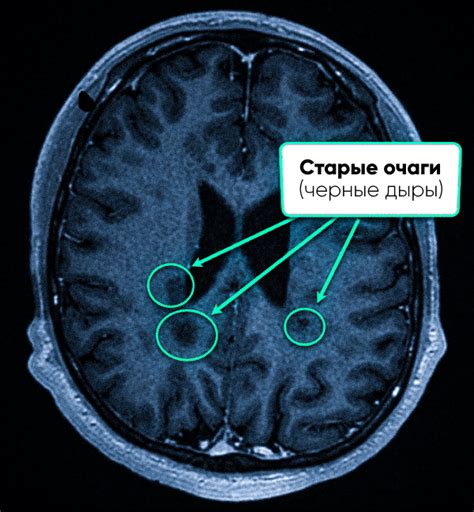 Продвинутые признаки демиелинизирующего процесса головного мозга