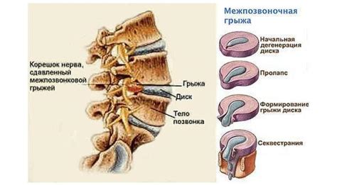 Профилактика дорзальных протрузий дисков
