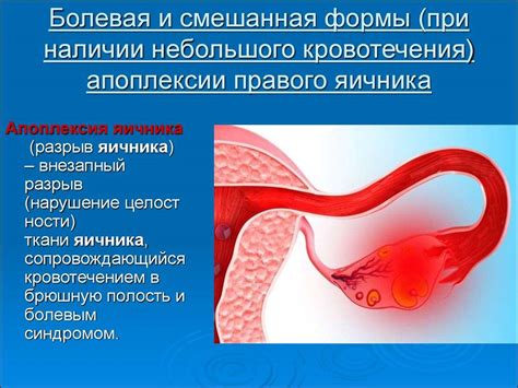 Профилактика и лечение высокого расположения яичника