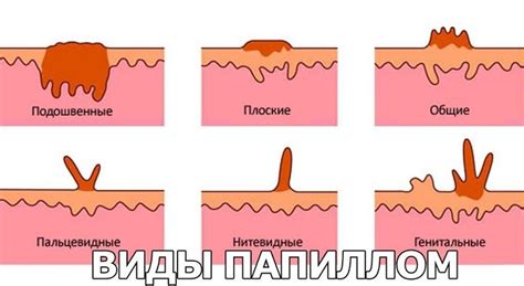 Профилактика папиллом: как предотвратить их появление на теле