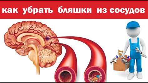 Профилактика сужения сосудов головного мозга