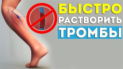 Профилактика тромбоза