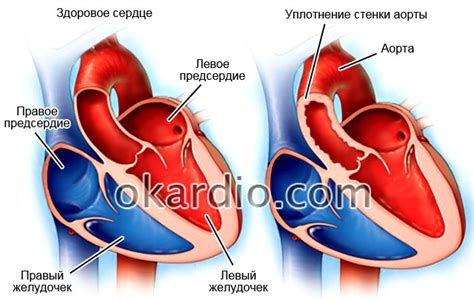 Профилактика уплотнения стенок восходящей аорты