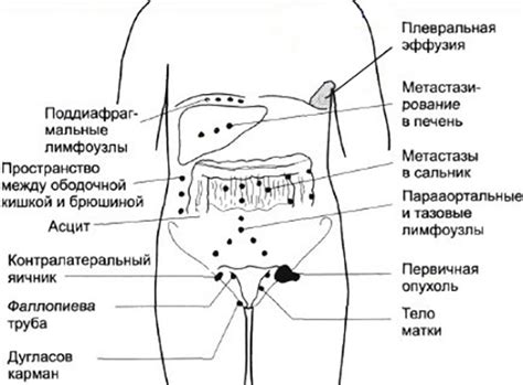 Профилактические меры для предотвращения возникновения лимфоузлов в паху у женщин