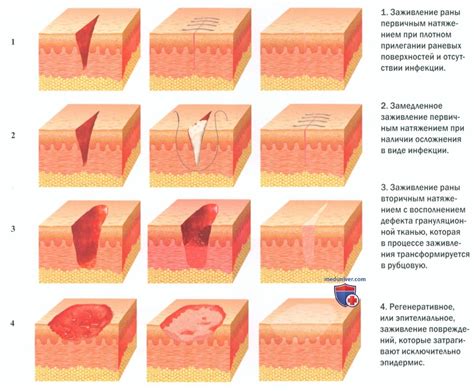 Процессы заживления раны без шва