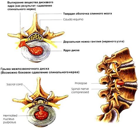 Развитие грыж