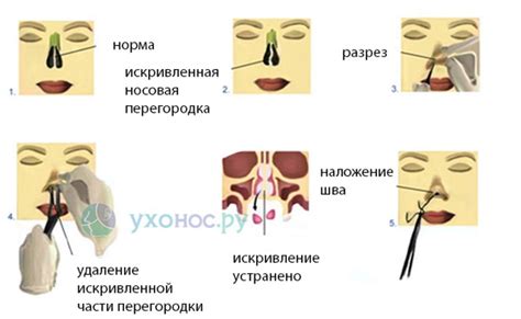 Различные методы выполнения вазотомии